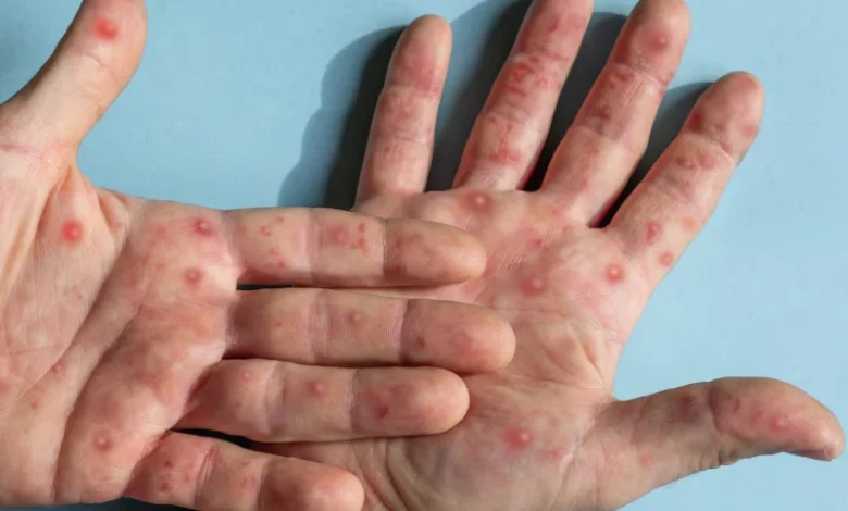 Viruela del mono. Foto/ Cortesía