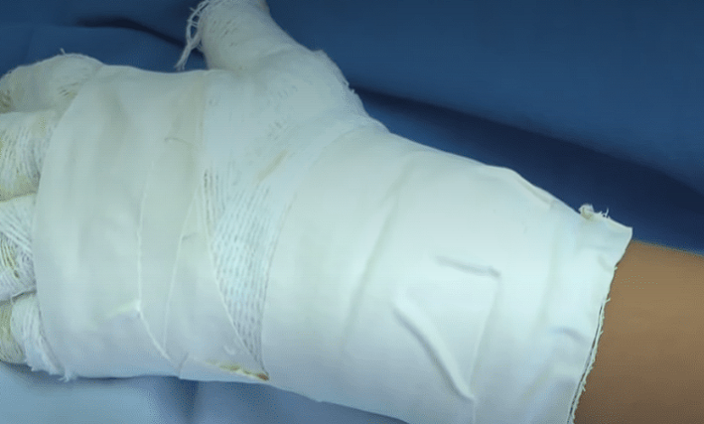 Un niño de 8 años resultó quemado con pólvora. Foto/ Cortesía